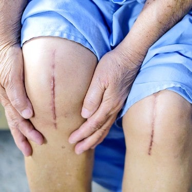 Knee Replacement Surgery